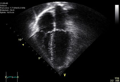 心臓超音波検査の画像